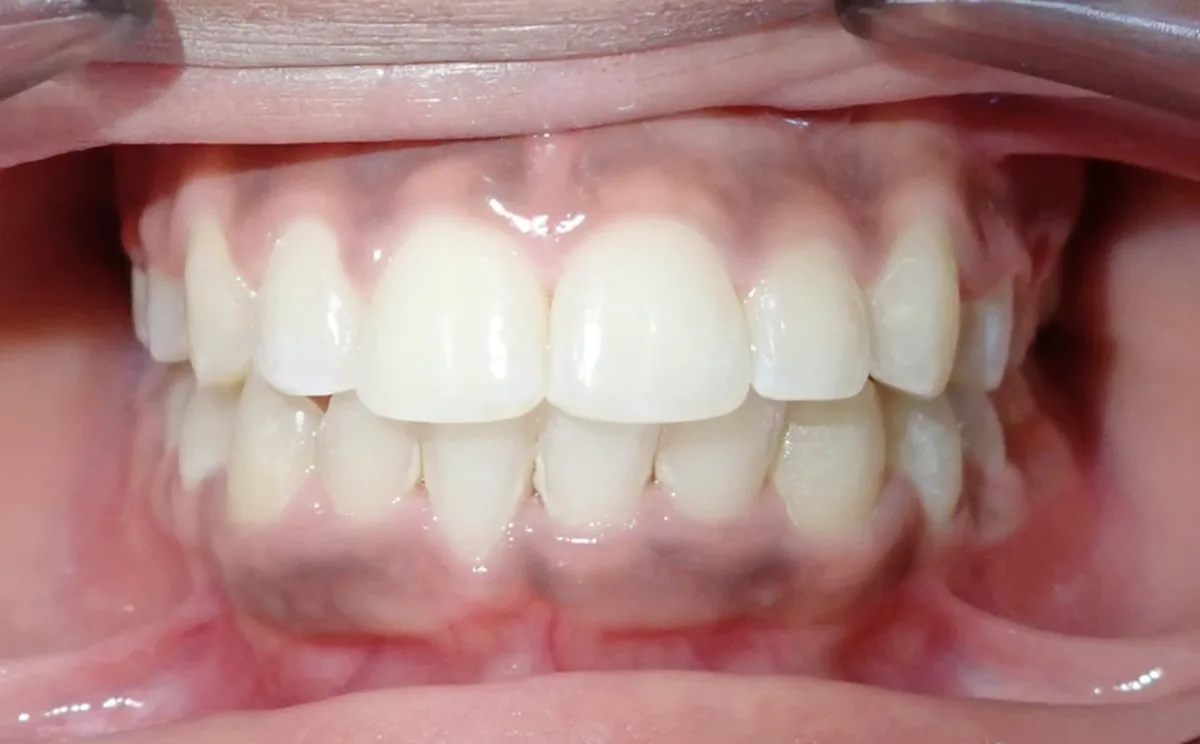 After orthodontic treatment – patient 1