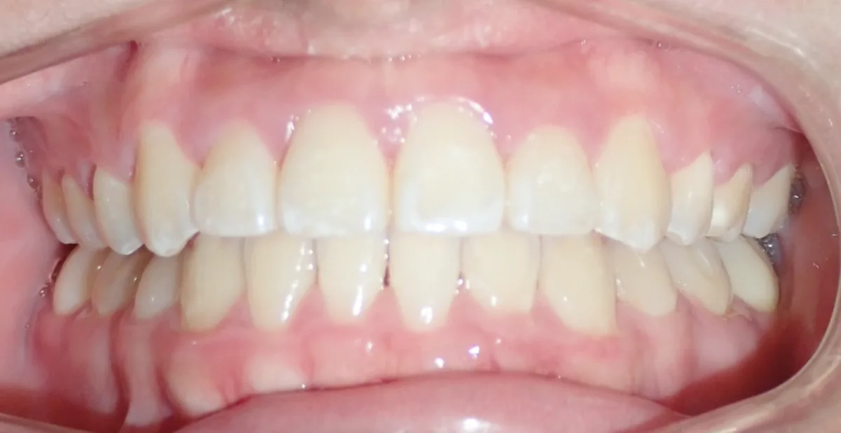 After orthodontic treatment – patient 4