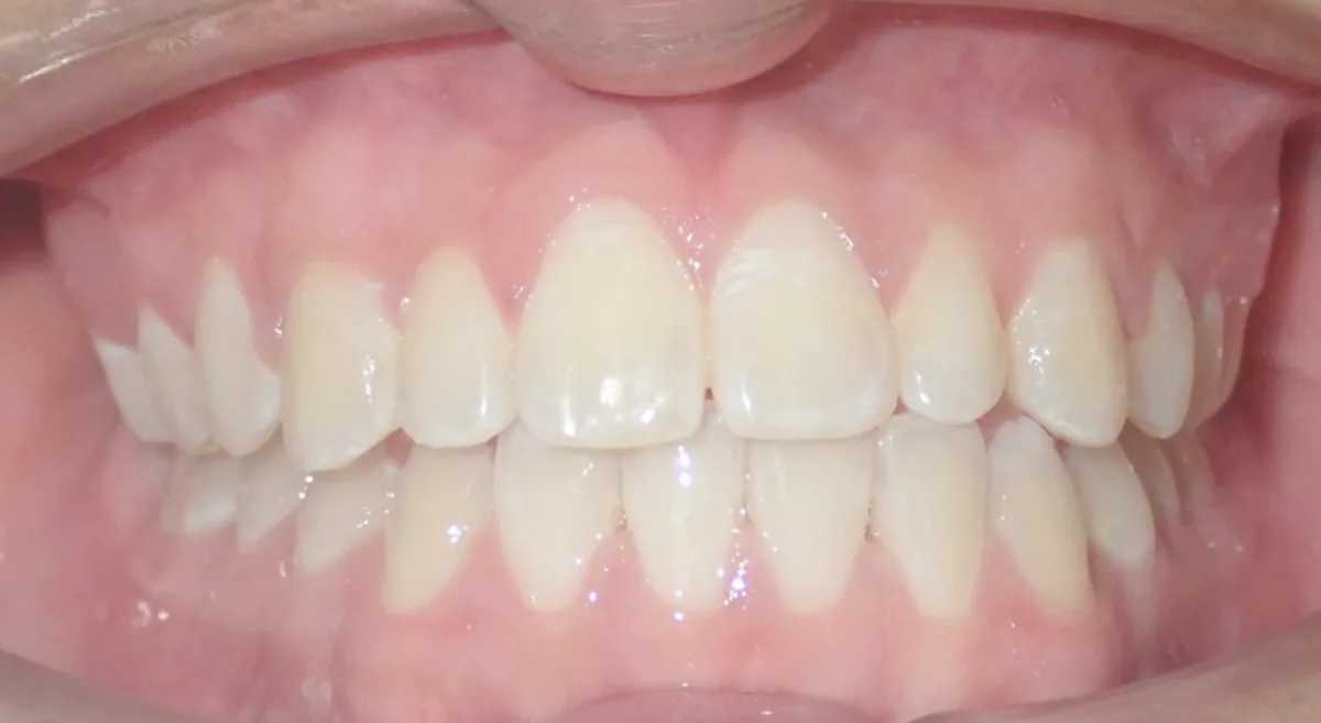 After orthodontic treatment – patient 5