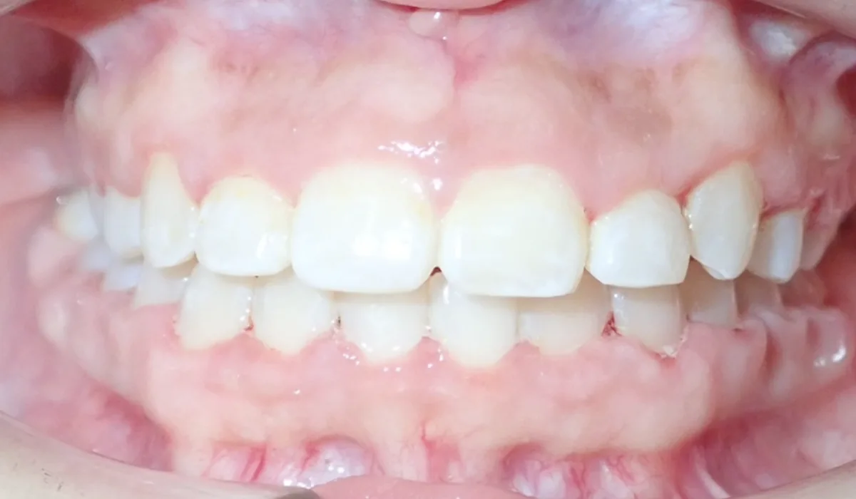 After orthodontic treatment – patient 7