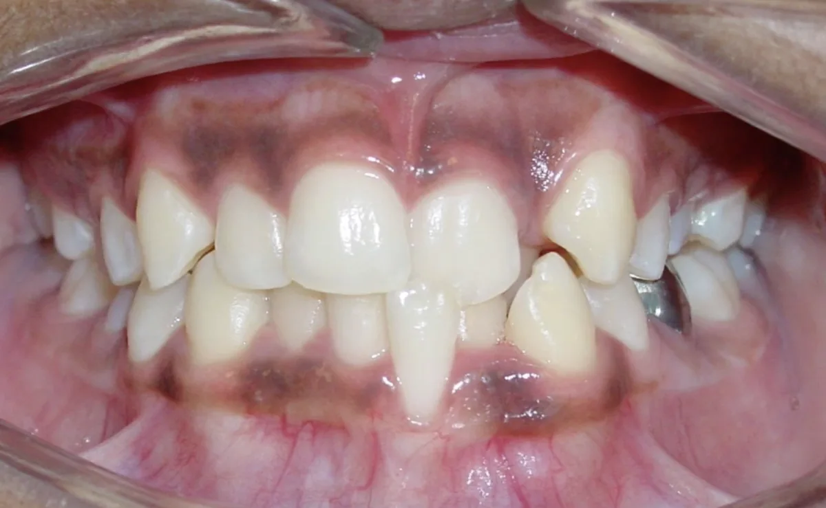 Before orthodontic treatment – patient 1