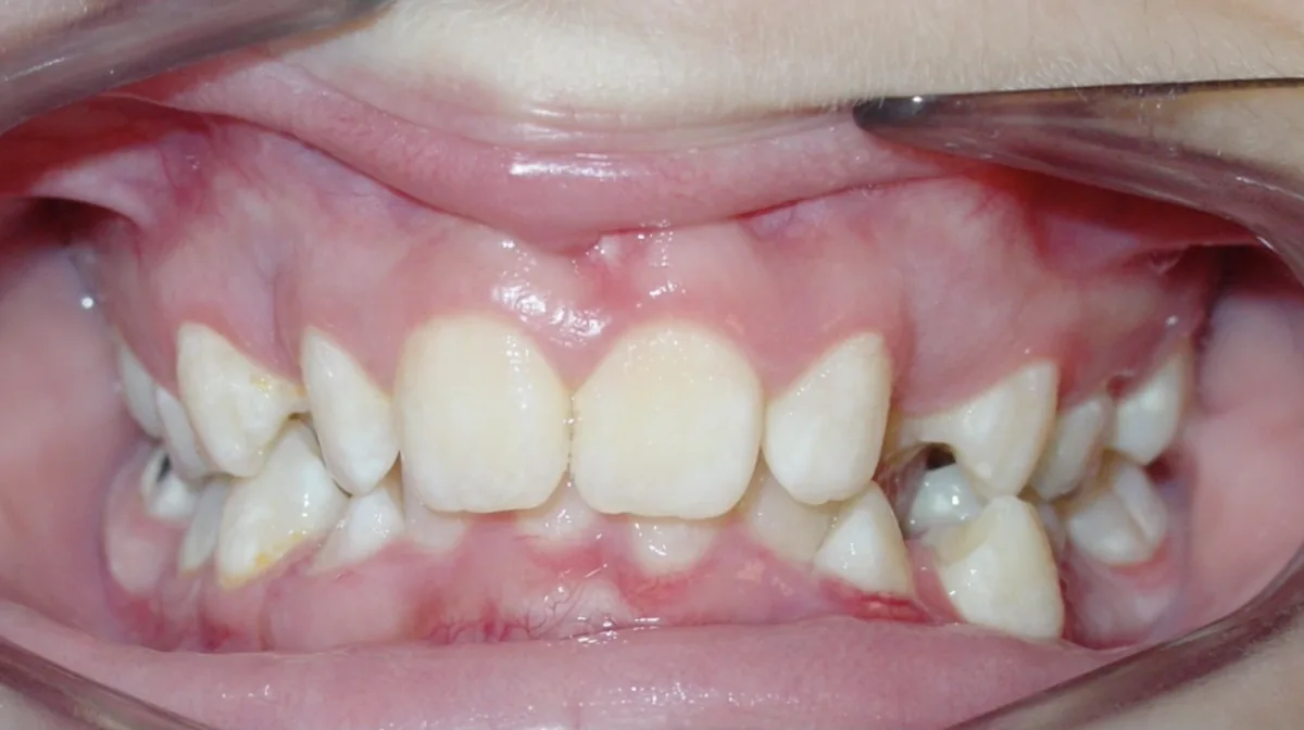 Before orthodontic treatment – patient 2