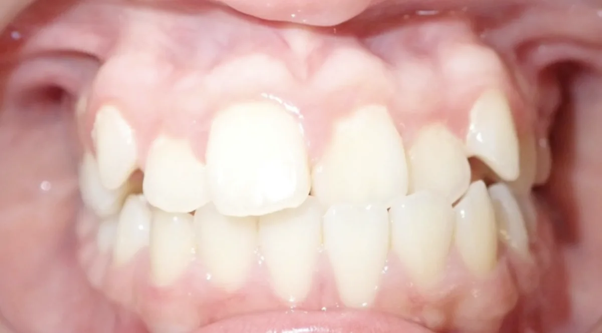Before orthodontic treatment – patient 3