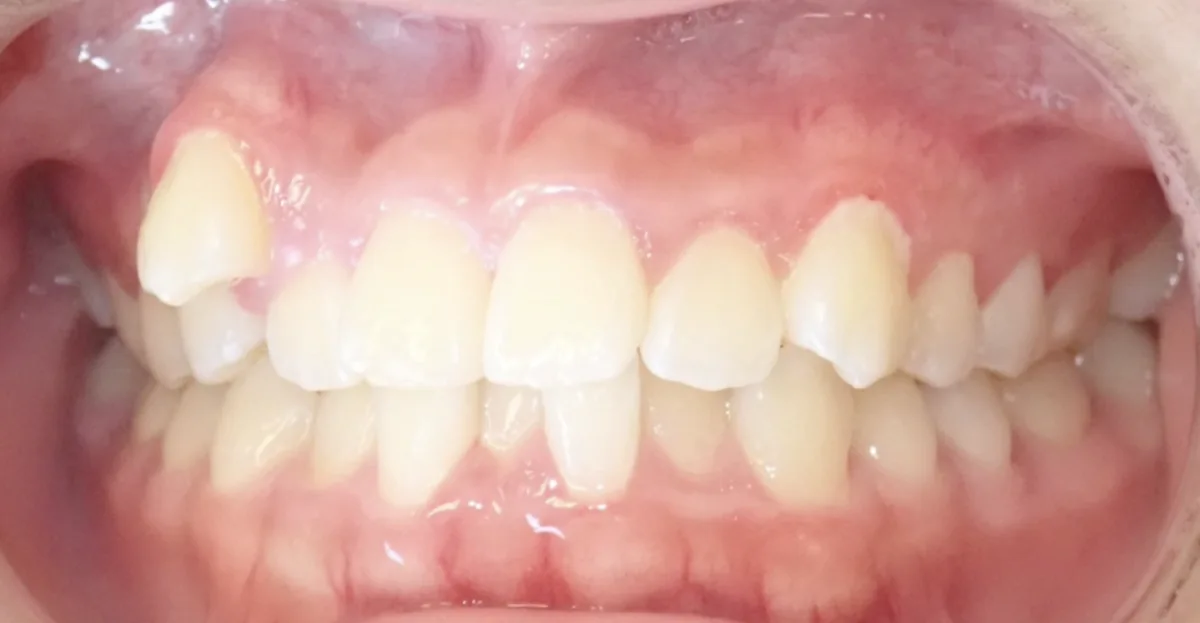 Before orthodontic treatment – patient 4