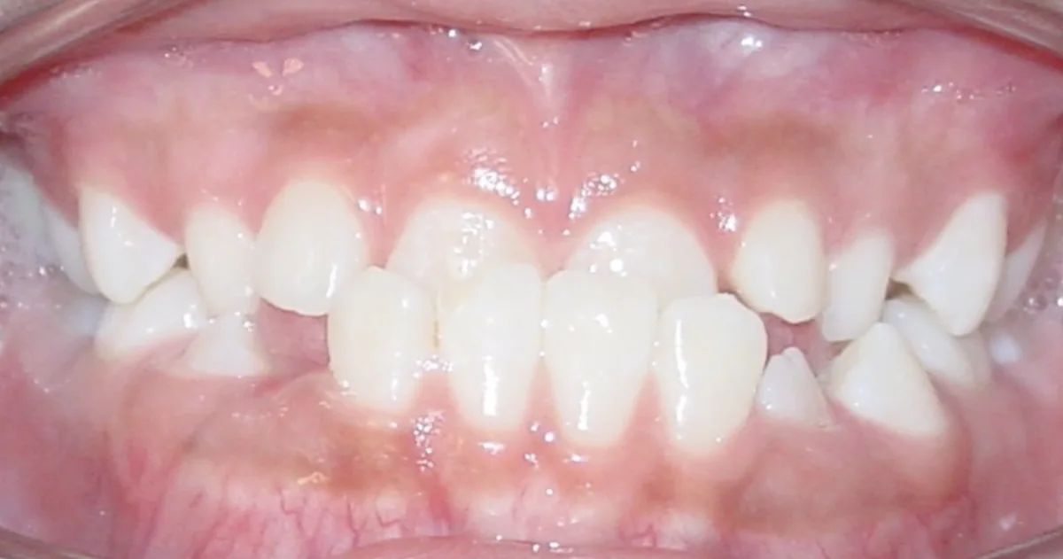 Before orthodontic treatment – patient 5