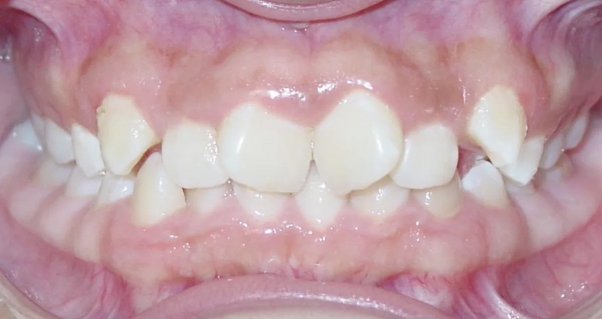 Before orthodontic treatment – patient 7