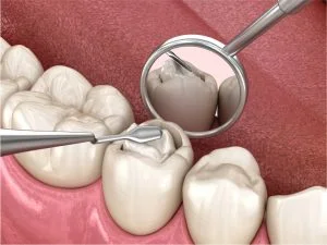 Before and after anterior composite restoration at iCare Orthodontics and Dentistry in Norcross, GA