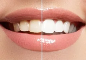 Zoom teeth whitening result at iCare Orthodontics and Dentistry in Norcross, GA